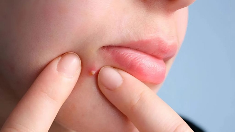 Hút mủ mụn nhọt: Phương pháp khoa học nhất 1