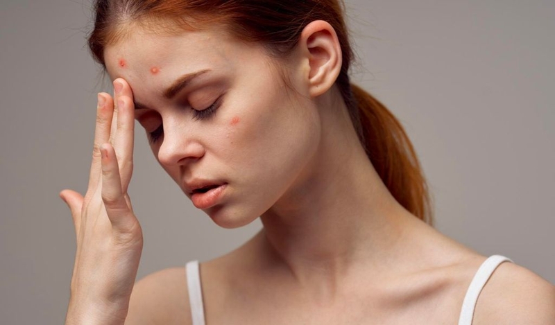 Hút vape có nổi mụn không? Tác hại của hút vape với sức khỏe? 1