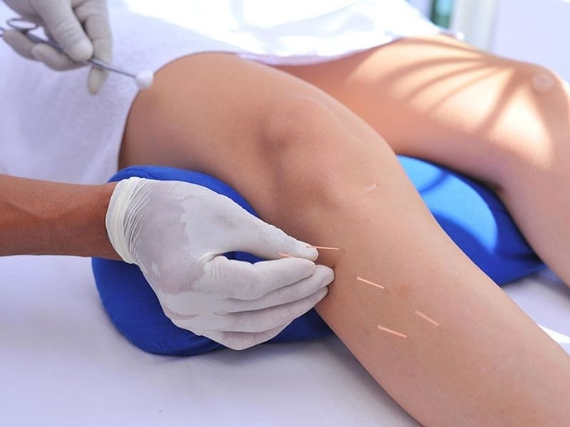 Châm cứu là phương pháp tác động lên huyệt vị Âm Lăng Huyền điều trị bệnh phổ biến