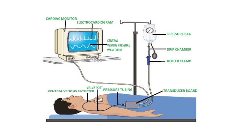 Huyết áp tĩnh mạch: Yếu tố quan trọng trong quản lý bệnh lý tim mạch 2