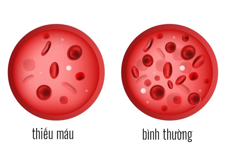 Huyết hư là gì? Nên làm gì khi bị huyết hư 2