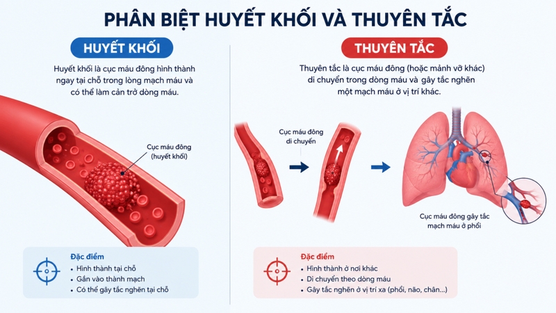 Minh họa sự khác biệt giữa huyết khối và thuyên tắc