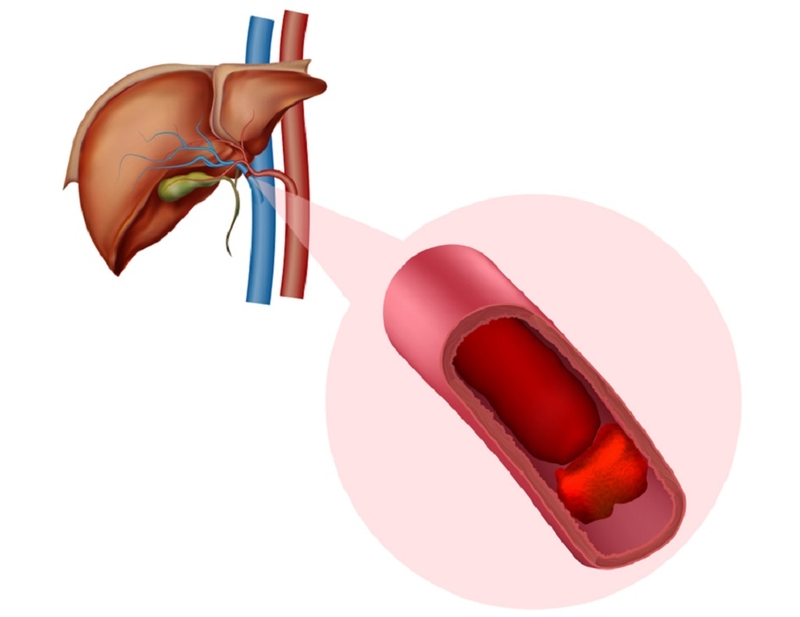 huyết khối tĩnh mạch cửa 1