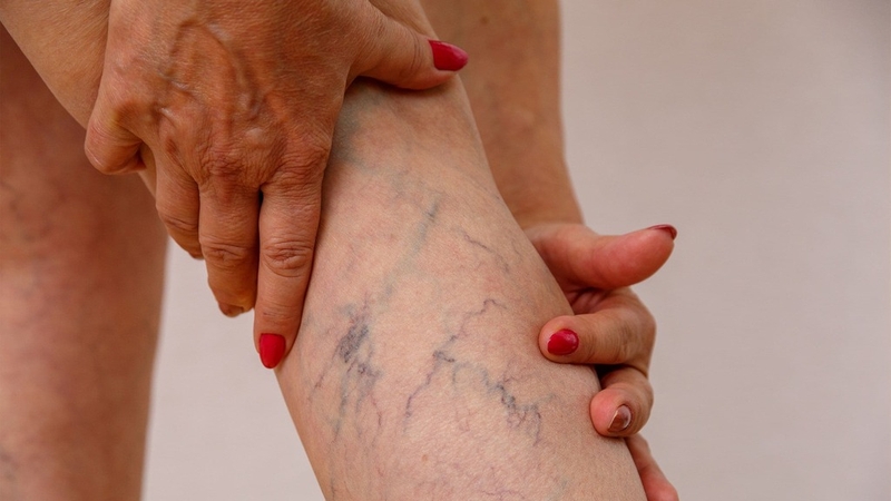 Huyết khối tĩnh mạch nông là gì? Điều trị và phòng ngừa như thế nào? 1