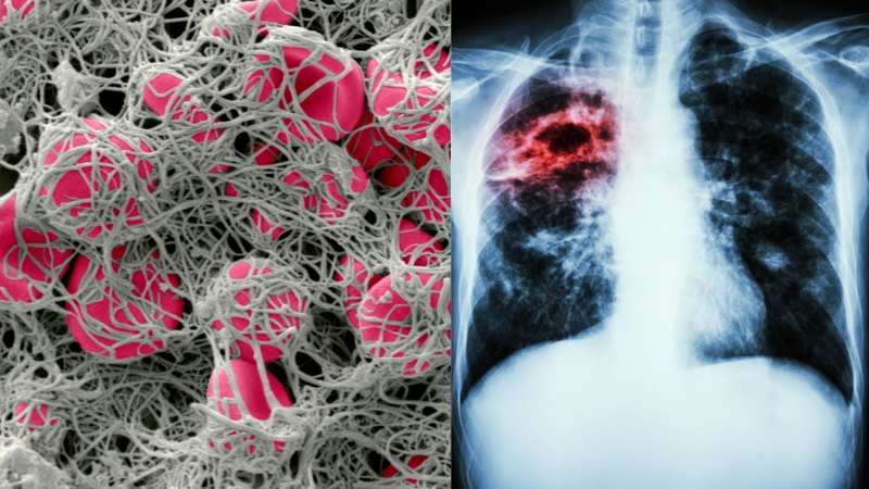 Huyết khối và thuyên tắc phổi: Nguy hiểm tiềm ẩn và cách nhận biết sớm 1