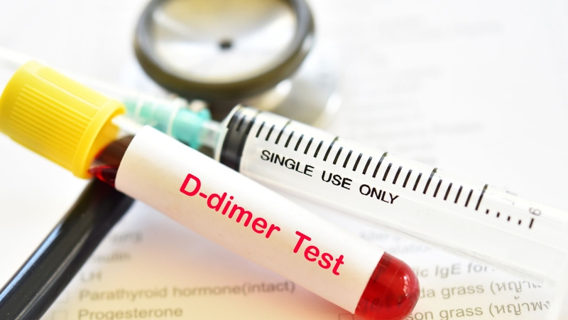 Huyết khối và thuyên tắc phổi: Nguy hiểm tiềm ẩn và cách nhận biết sớm 2