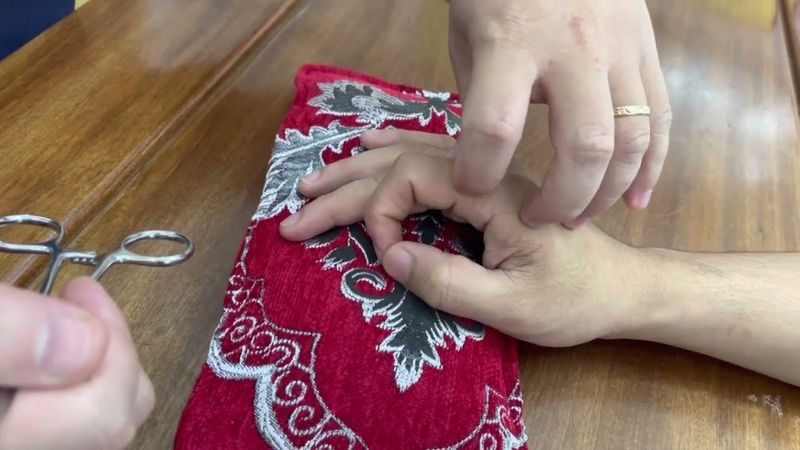 Huyệt Nhị Gian: Vị trí, cách xác định và tác dụng đối với sức khỏe 3