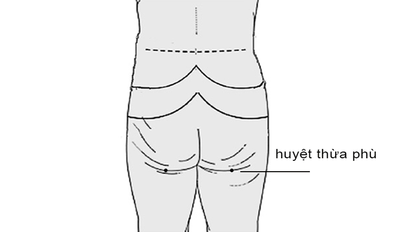Huyệt Thừa Phù là gì