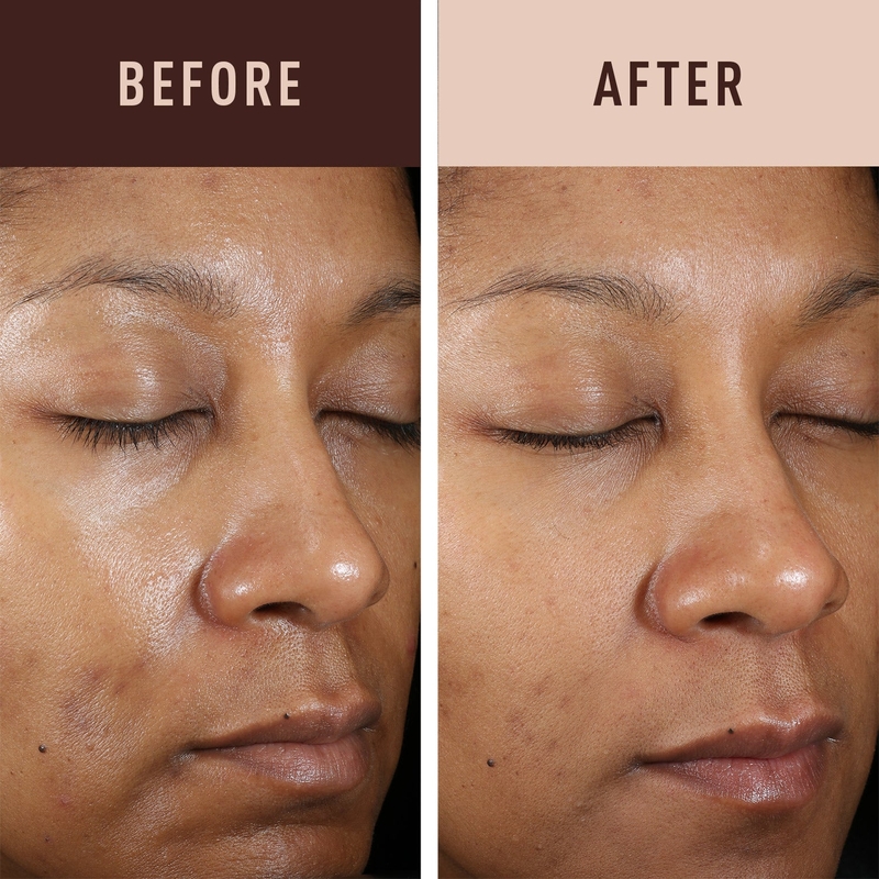 Hydroquinone là gì? Công dụng và cách sử dụng an toàn 5