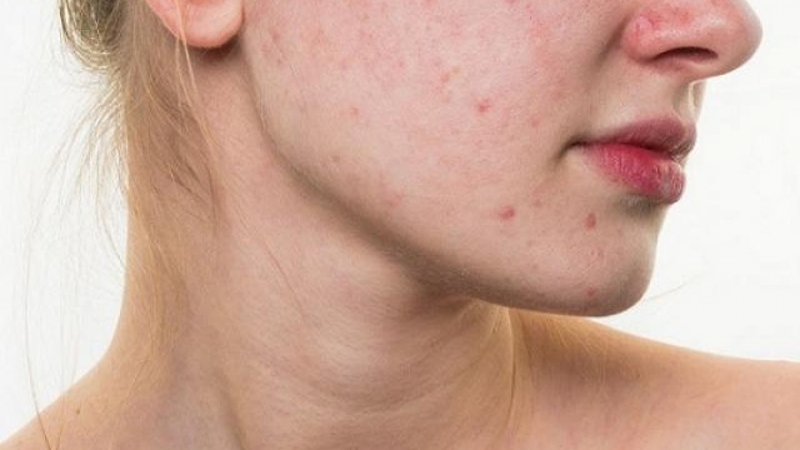 Hypoallergenic là gì trong mỹ phẩm, có an toàn cho da? 2
