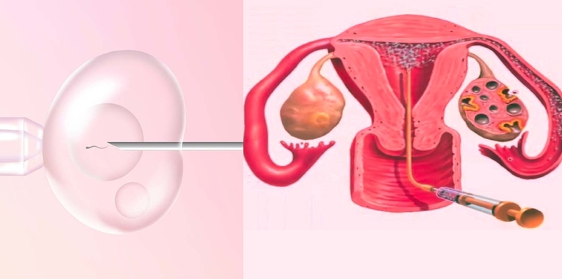 iui-va-ivf-la-gi-nen-lua-chon-phuong-phap-nao-giua-iui-va-ivf 2.jpg