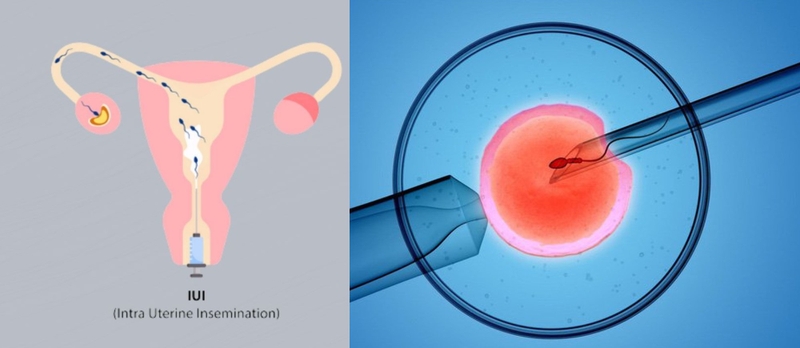 iui-va-ivf-la-gi-nen-lua-chon-phuong-phap-nao-giua-iui-va-ivf 3.jpg