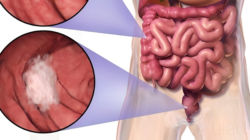 K trực tràng thấp: Nguyên nhân, triệu chứng và cách điều trị 4