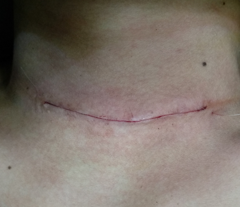 K tuyến giáp là gì? Tiên lượng K tuyến giáp? 3