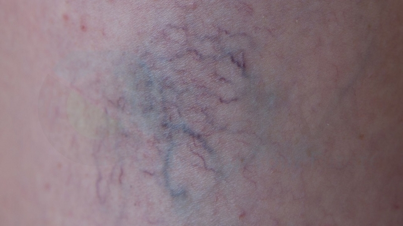 Kem bôi da Fucidin có chứa Corticoid không? Lưu ý khi sử dụng Fucidin 4