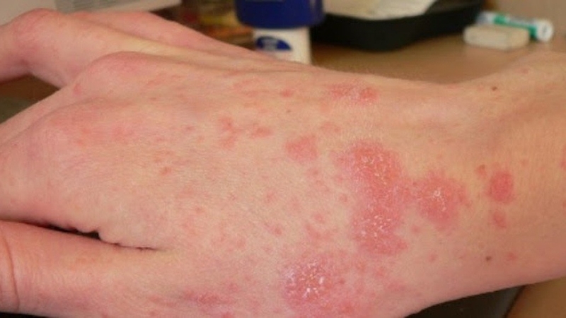 Kem bôi Urgo Eczekalm: Hỗ trợ điều trị viêm da và khô da 3