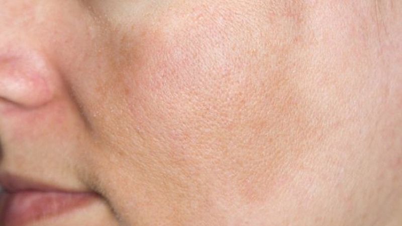 Kem chống nắng góp phần hỗ trợ quá trình điều trị thâm nám trên da