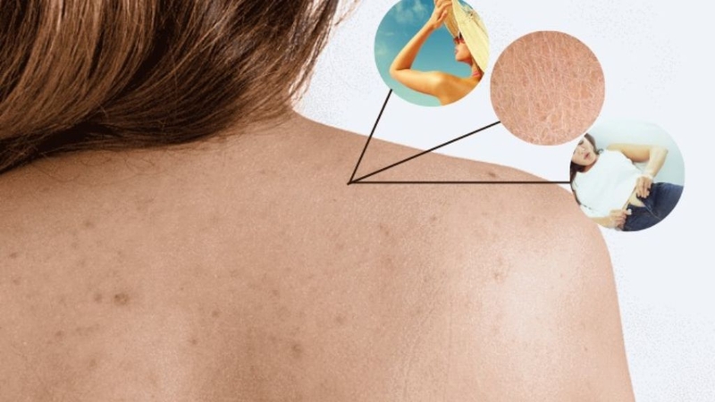 Kem mờ thâm Fixderma Nigrilite Cream: Lành tính, an toàn cho da! 1