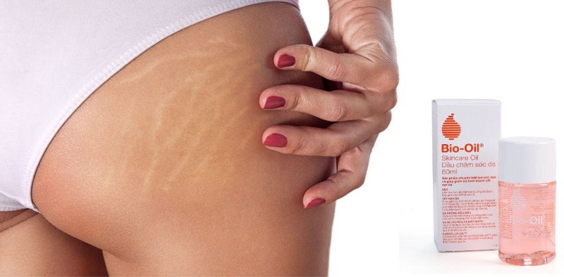 kem trị rạn da mông 1