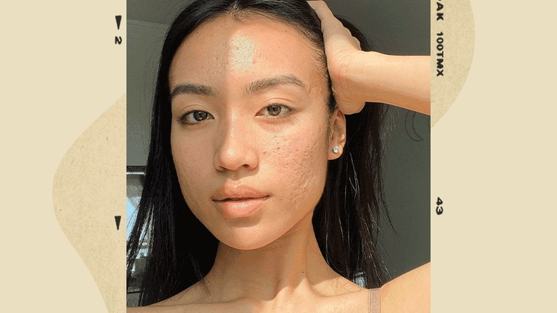 kem trị sẹo lõm 1