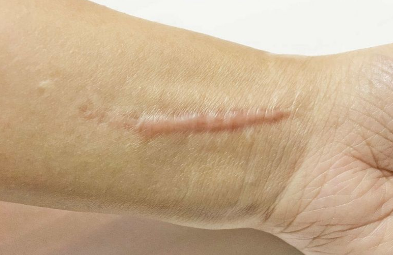 Kem trị sẹo Strataderm có thật sự tốt hay chỉ là lời đồn? 1