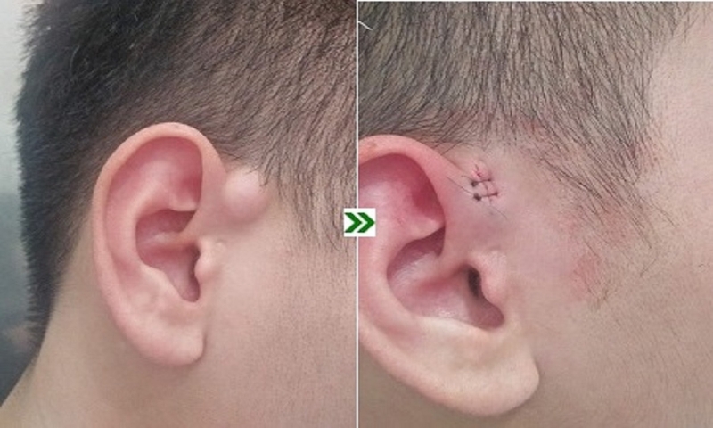 Kén bã đậu ở trẻ là bệnh gì? Kén bã đậu có nguy hiểm không? 4