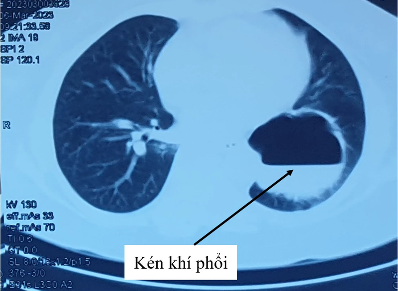 Kén khí phổi: Nguyên nhân, triệu chứng và cách chữa trị 2