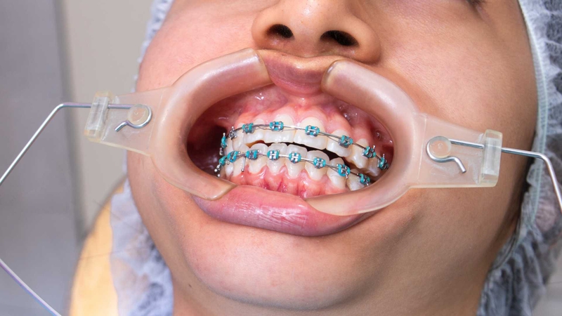 Lực kéo từ mắc cài và chun chuỗi giúp răng dịch chuyển đúng hướng và ổn định