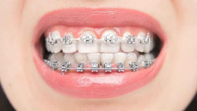 Kéo cụm 4 răng cửa là giai đoạn chỉnh nha để di chuyển 2 răng cửa giữa và 2 răng cửa bên