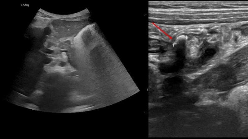 Kết quả siêu âm viêm ruột thừa​: Một số hình ảnh và những lưu ý quan trọng 2
