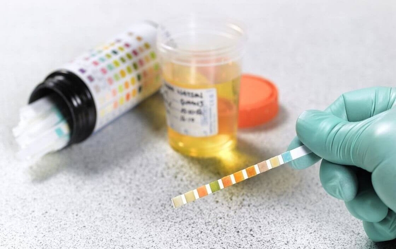 Ketone là gì? Ý nghĩa của xét nghiệm ketone trong nước tiểu