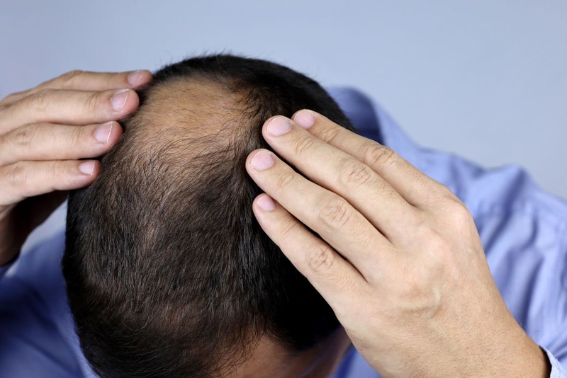 Khắc phục rụng tóc bằng cách nào hiệu quả 3