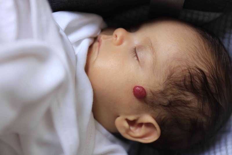 Khám bướu máu ở đâu uy tín cho trẻ? - 1