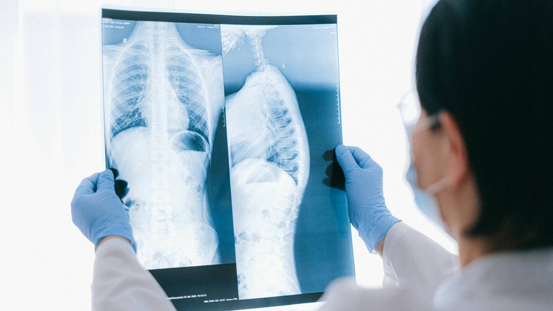Tùy từng trường hợp, bác sĩ có thể yêu cầu bệnh nhân chụp X quang ngực