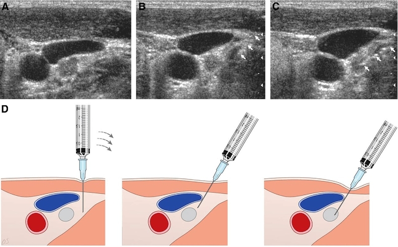 Khám lách to như thế nào? 3