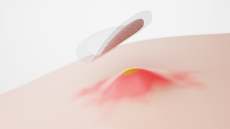 Khám phá: Cơ chế hình thành mụn và một số lưu ý khi điều trị mụn 4