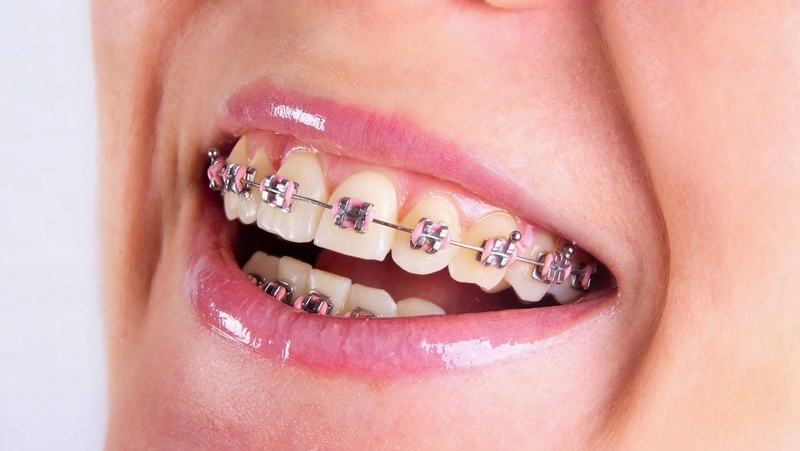 Khám phá giai đoạn xấu nhất khi niềng răng và cách vượt qua 1