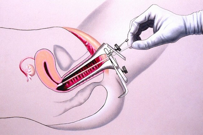 Khám phá ngay những điều cần biết về sinh thiết cổ tử cung 1