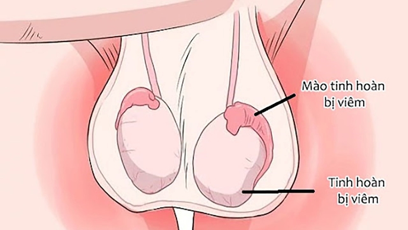 Khám tinh hoàn có thể phát hiện những bệnh lý gì? 2