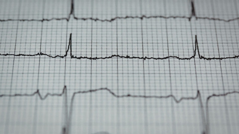 Điện tim (ECG) có thể là một trong những hạng mục khác