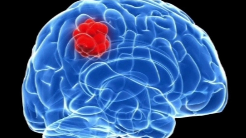 Khám u não ở đâu uy tín và chất lượng tại TP. Hồ Chí Minh? 1