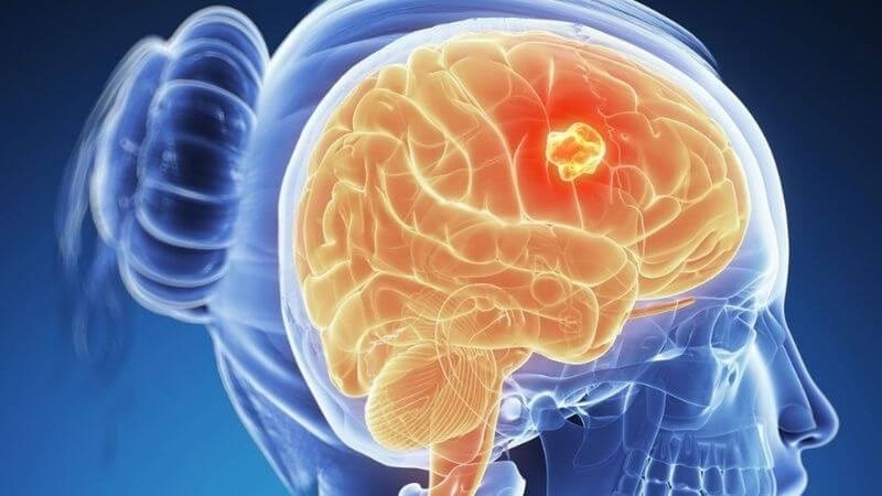 Khám u não ở đâu uy tín và chất lượng tại TP. Hồ Chí Minh? 2