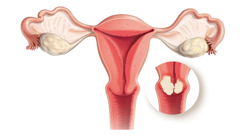 Khám ung thư cổ tử cung gồm những gì và nên khám khi nào?
