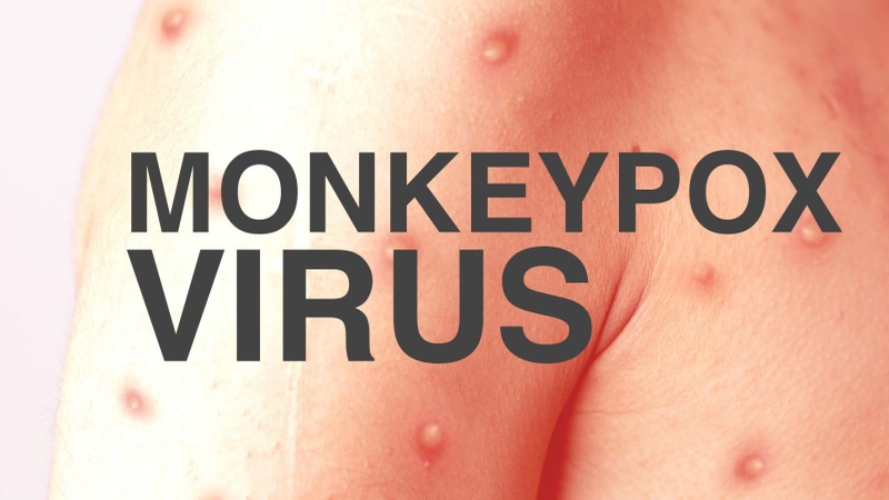 Khẩn cấp: TP.HCM đã ghi nhận ca nghi mắc đậu mùa khỉ đầu tiên1
