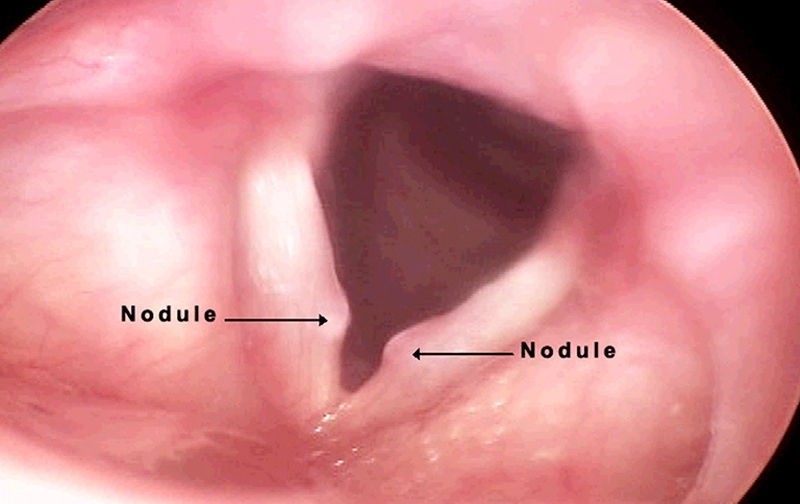 Khàn tiếng lâu ngày có nguy hiểm không? 3