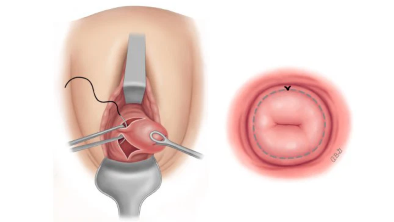 Khâu eo tử cung bao lâu thì quan hệ được? 1