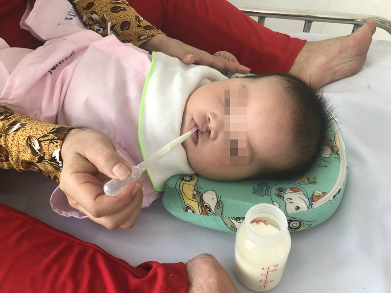 Khe hở vòm miệng: Nguyên nhân và lưu ý khi điều trị 2