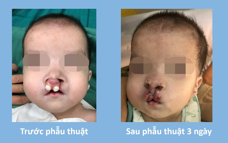 Khe hở vòm miệng: Nguyên nhân và lưu ý khi điều trị 3