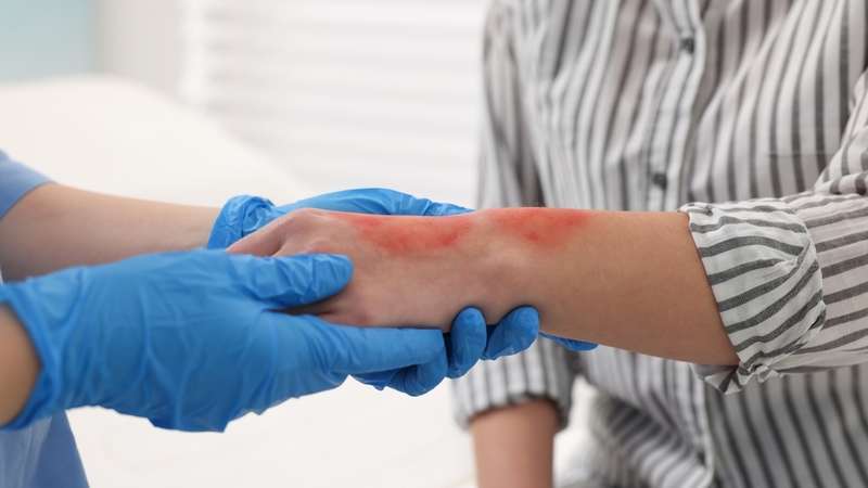 Nên đi khám nếu vết bỏng có dấu hiệu nặng như diện rộng, bỏng sâu hoặc nằm ở các vị trí nhạy cảm