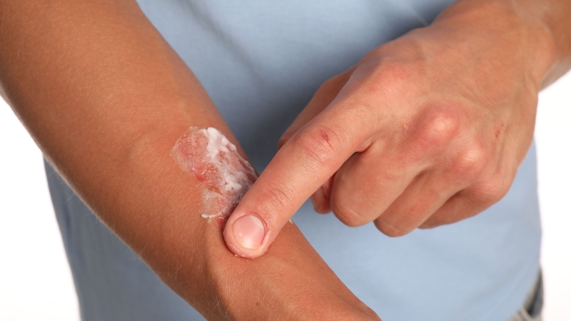 Không nên bôi các chất không được khuyến cáo như kem đánh răng, dầu, lòng trắng trứng